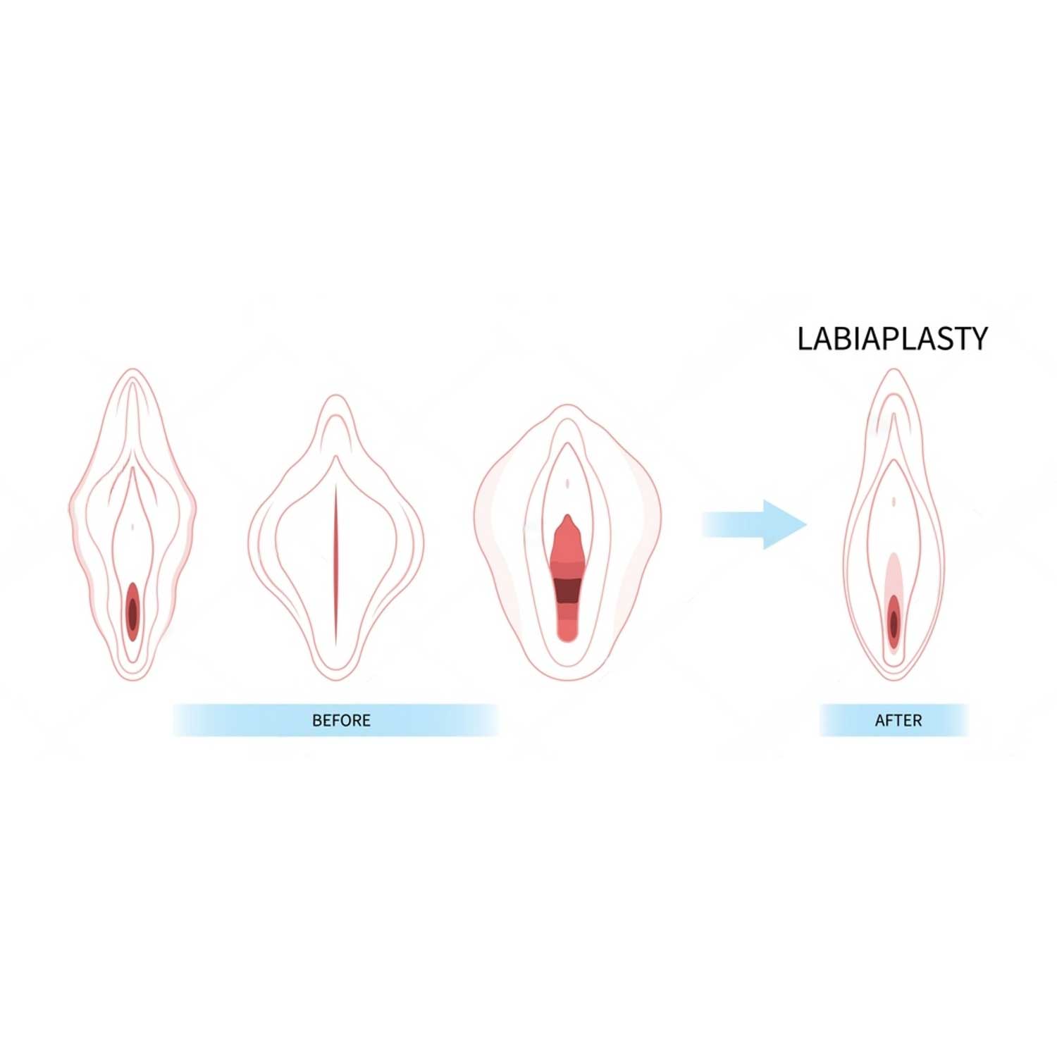 Labiaplasty 1 1