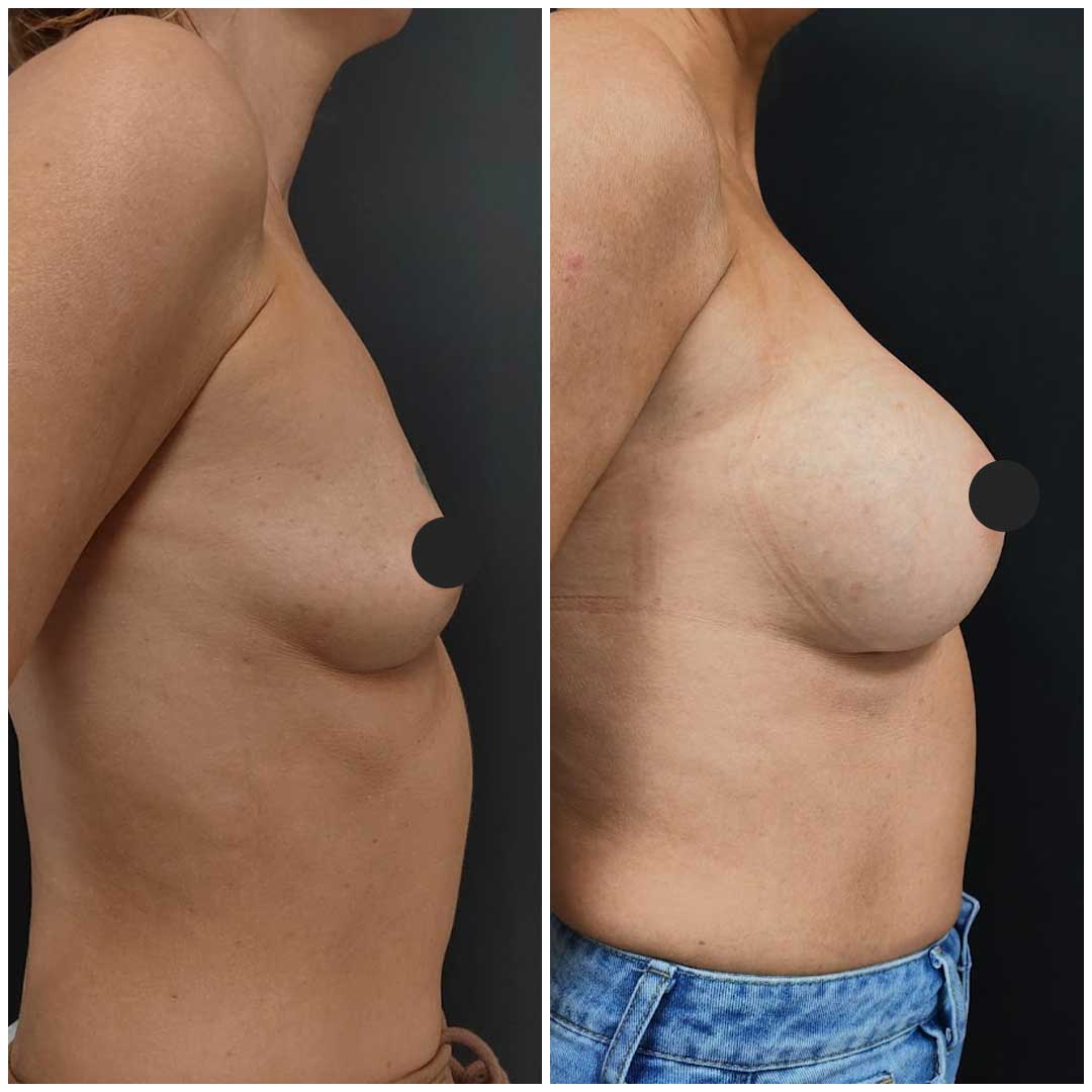 Breast Surgery before After