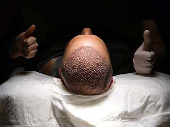 NewMe Health Clinic - Hair Transplant