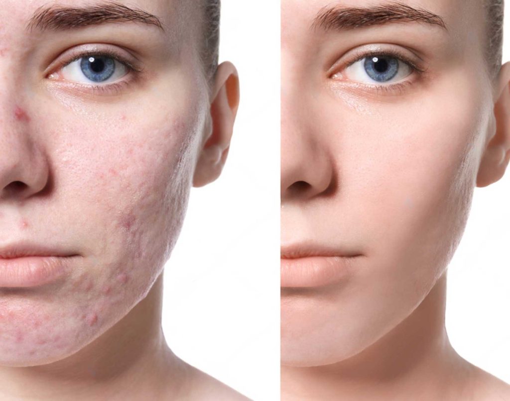 acne scar treatments 1