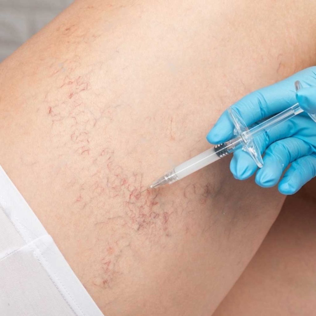 sclerotherapy newme health clinic