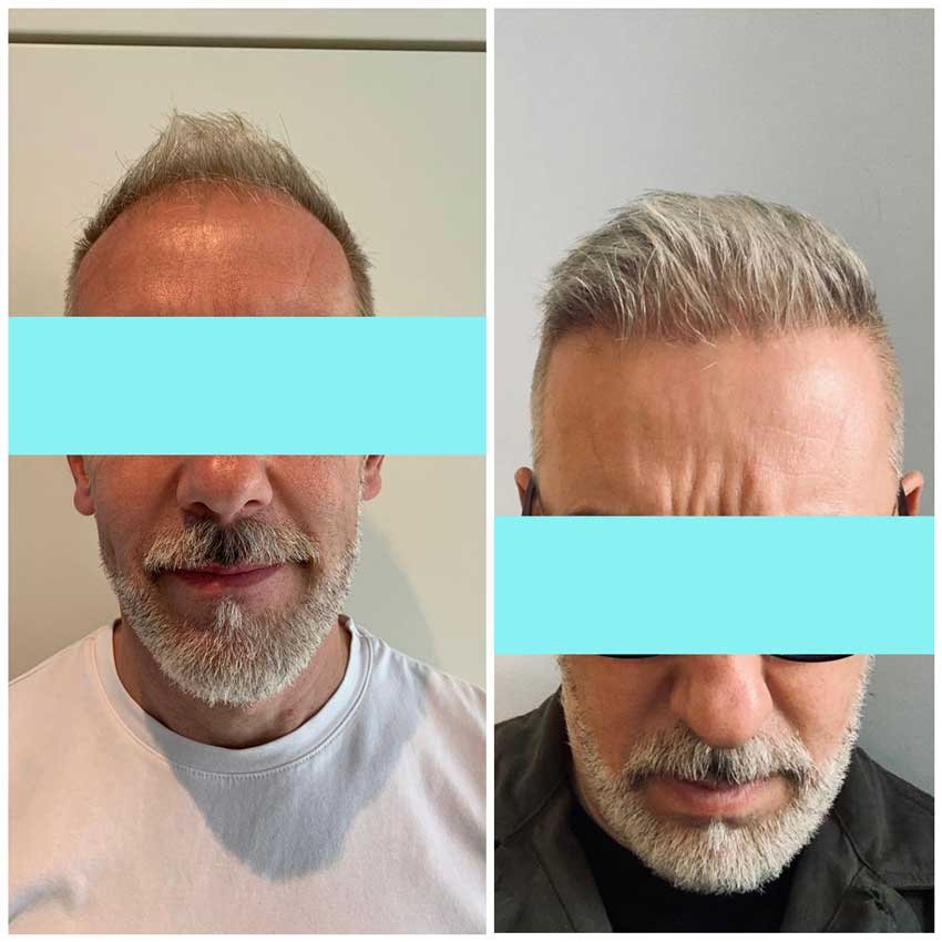 NewMe Health Clinic - Hair Transplant