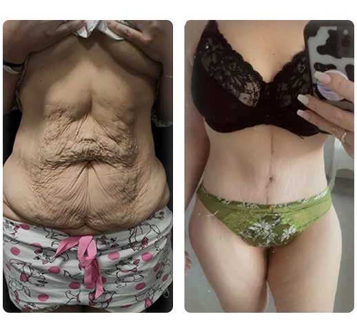 Tummy tuck before and after result at NewMe Health Clinic Antalya