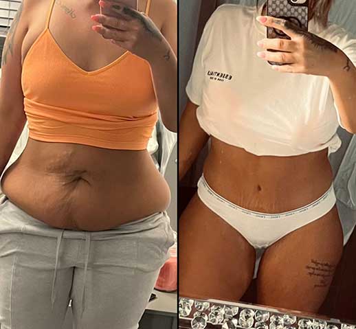 Tummy tuck before and after results at NewMe Health Clinic