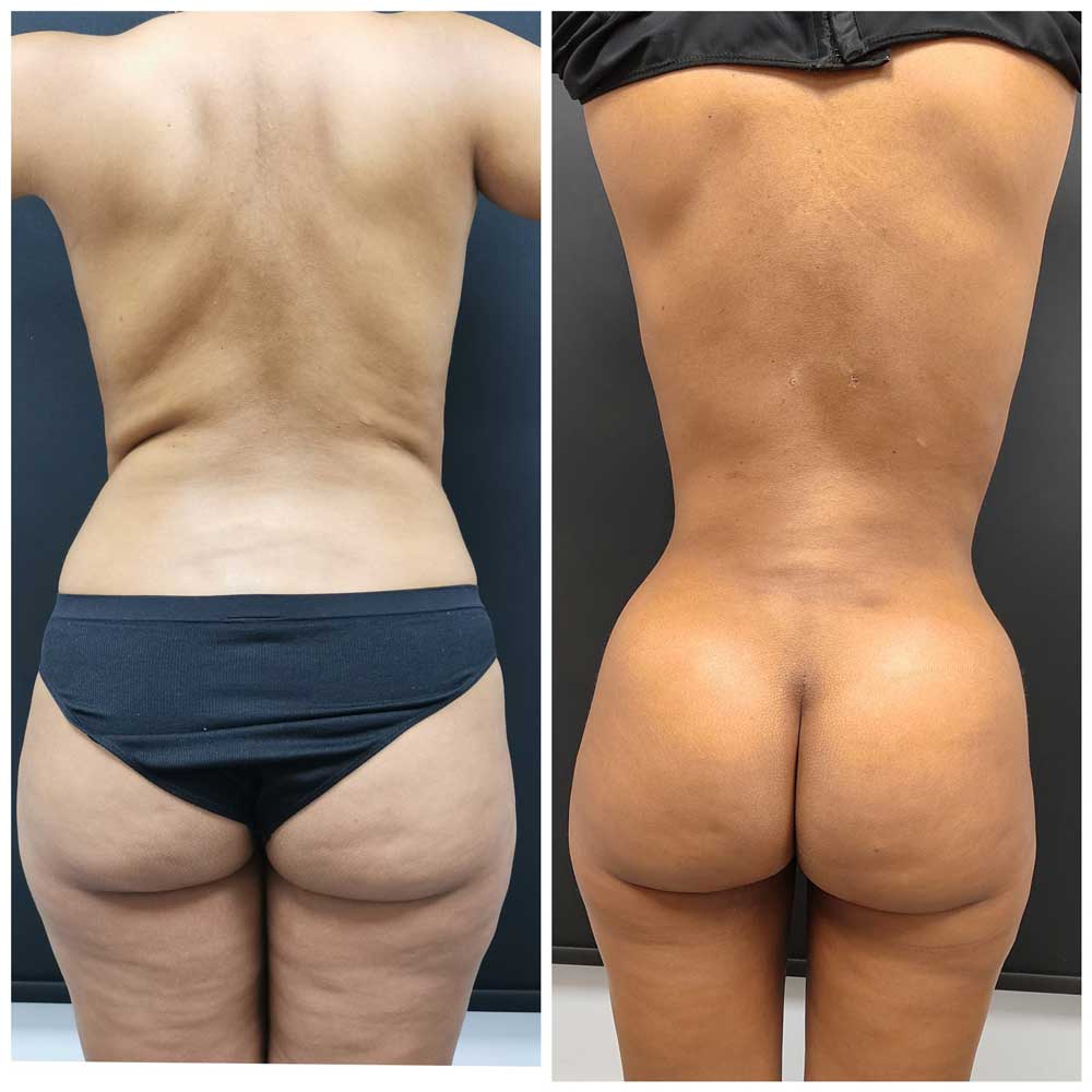 Brazilian Butt Lift BBL in Turkey