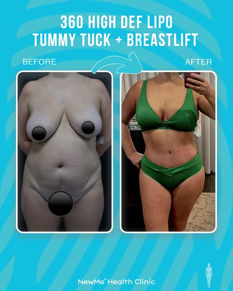 Bahadır 360° Tummy Tuck + HD Lipo + Breast Lift before and after — NewMe patient