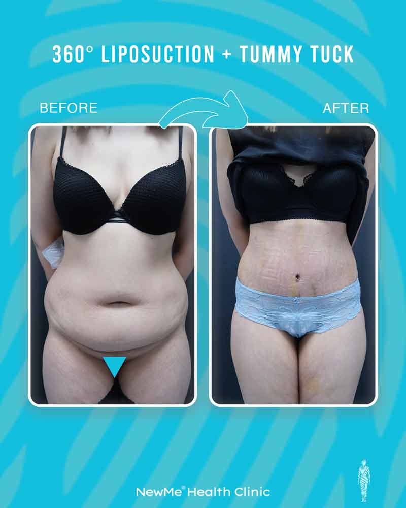 Bahadır 360° Tummy Tuck + Liposuction before and after — NewMe patient