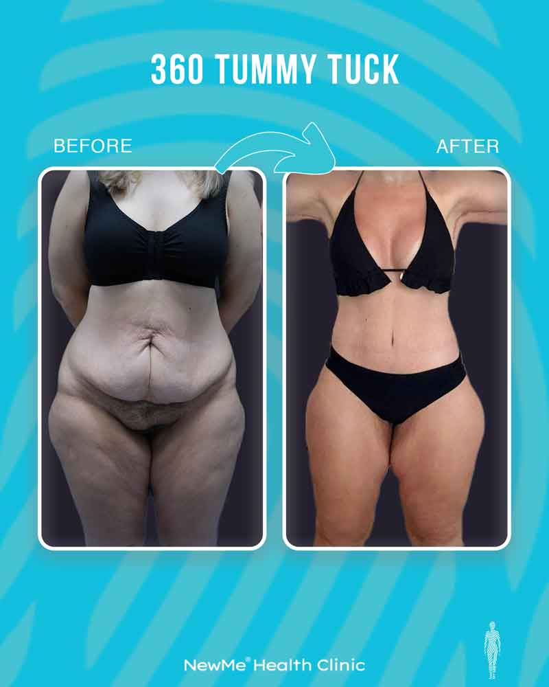 Bahadır 360° Tummy Tuck before and after — NewMe patient
