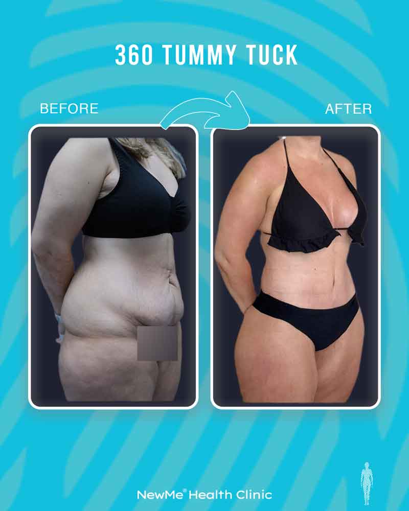 Bahadır 360° Tummy Tuck before and after — NewMe patient
