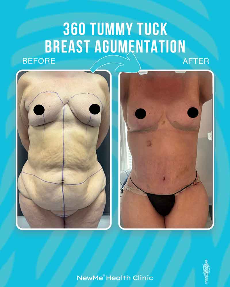 Bahadır 360° Tummy Tuck + Breast Augmentation before and after — NewMe patient