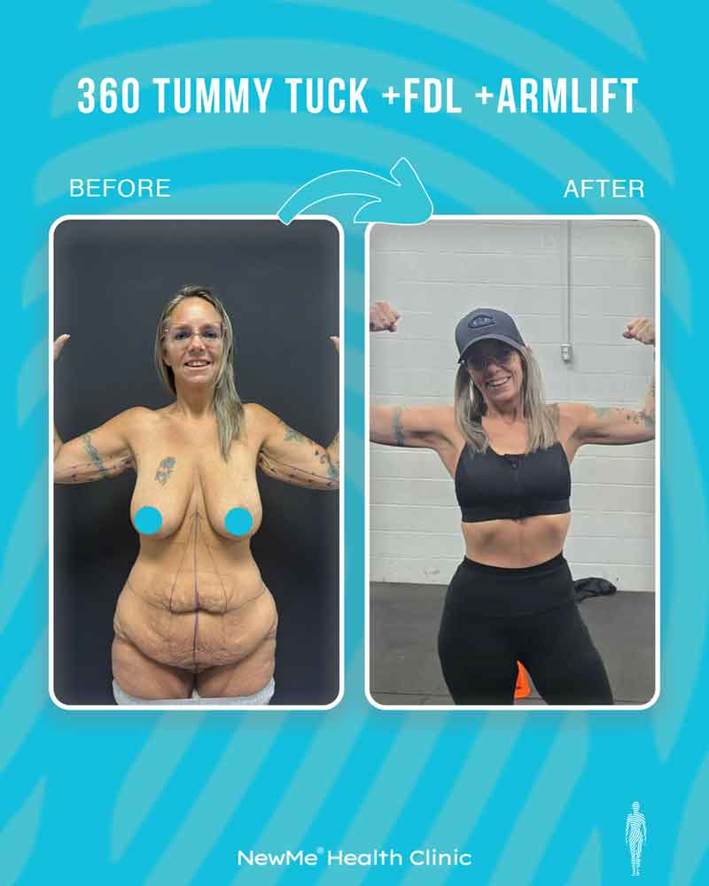 Arm lift combination surgery before and after — NewMe patient