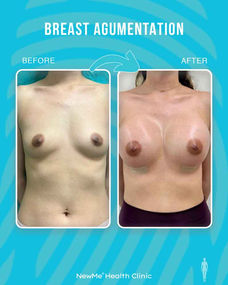 Breast surgery before and after — NewMe patient