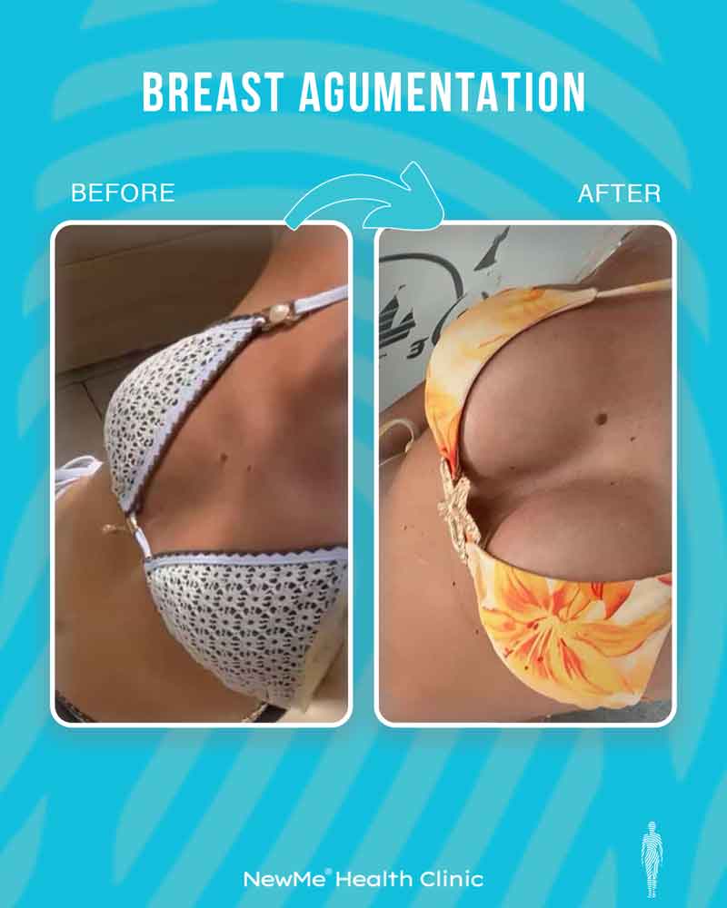 Breast surgery before and after — NewMe patient