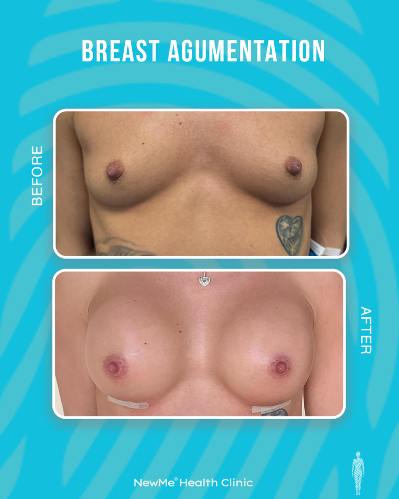 Breast surgery before and after — NewMe patient