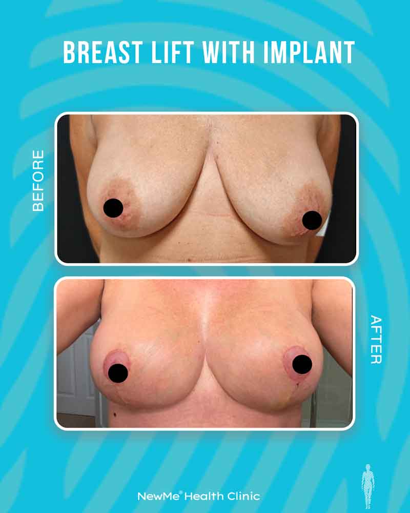 Breast surgery before and after — NewMe patient