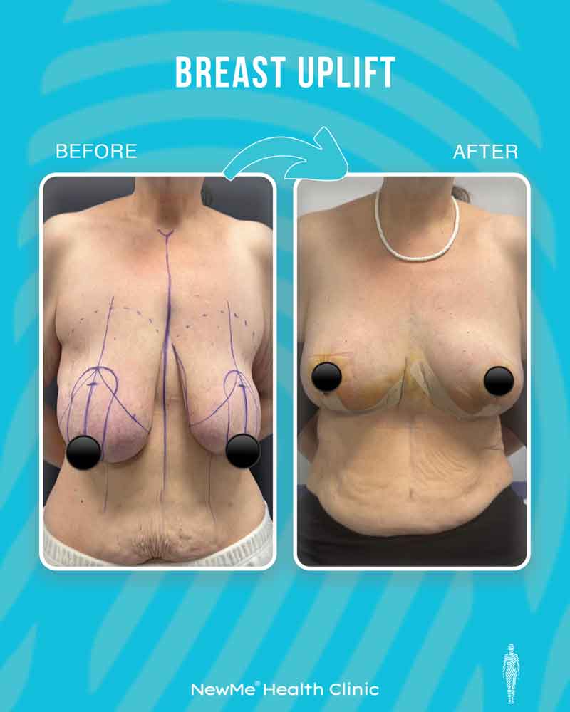 Breast surgery before and after — NewMe patient