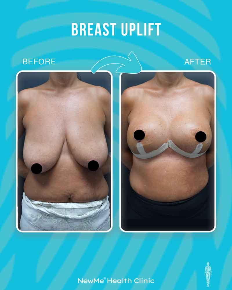 Breast surgery before and after — NewMe patient