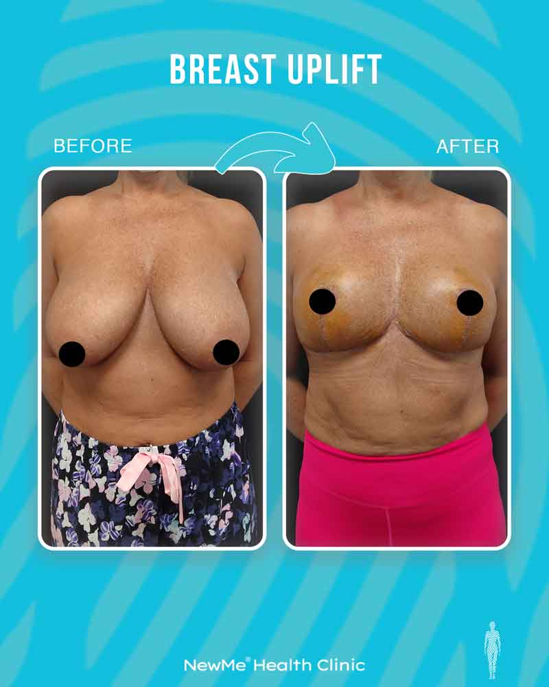 Breast surgery before and after — NewMe patient