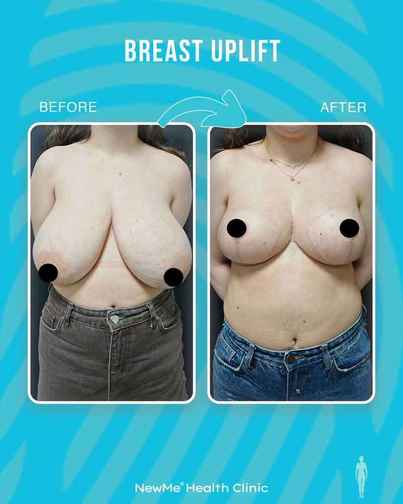 Breast surgery before and after — NewMe patient
