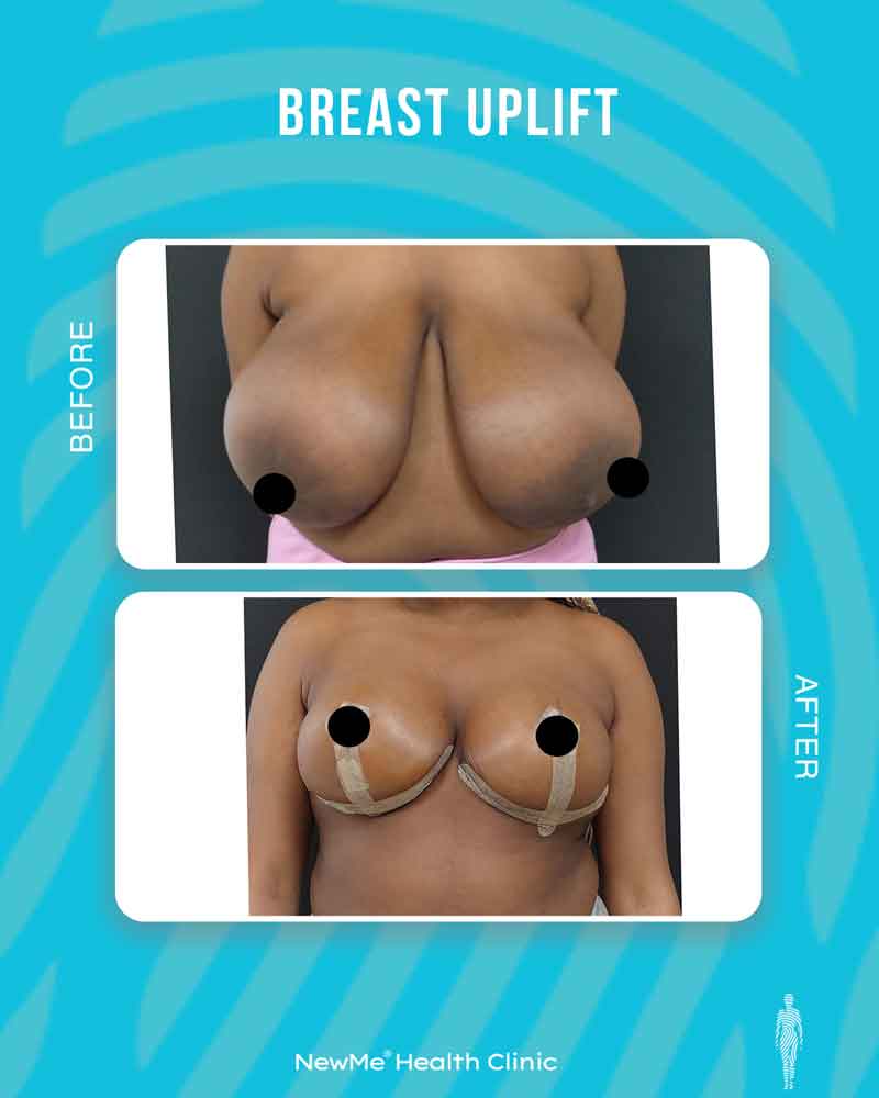 Breast surgery before and after — NewMe patient