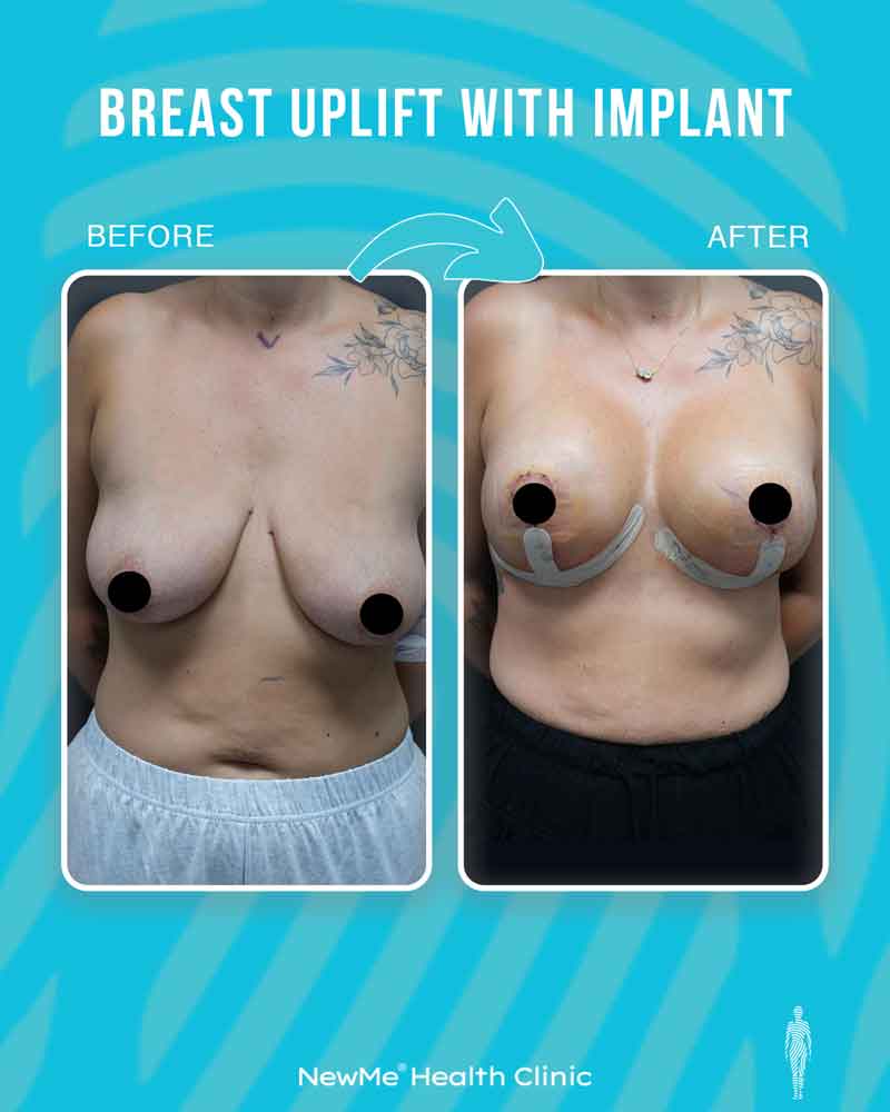 Breast surgery before and after — NewMe patient