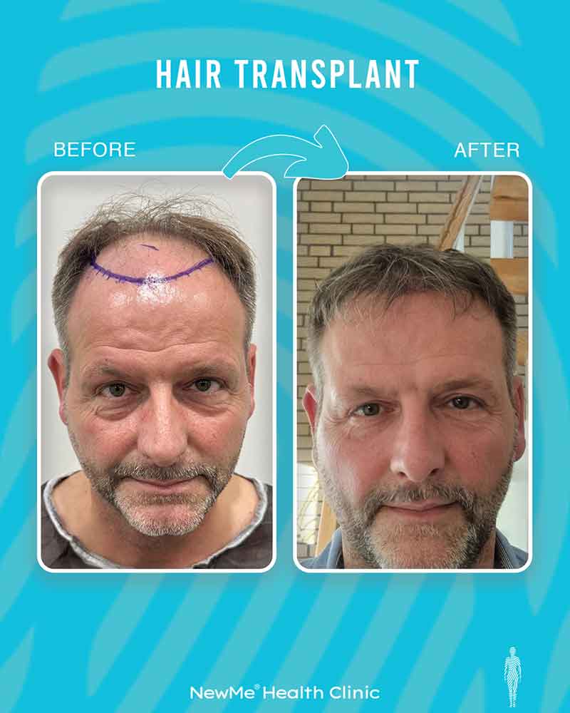 Hair transplant before and after — Dr. Okan Tanın, NewMe patient