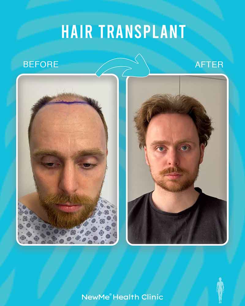 Hair transplant before and after — Dr. Okan Tanın, NewMe patient
