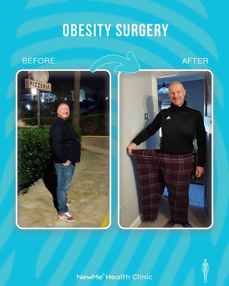 Weight loss surgery before and after — NewMe patient