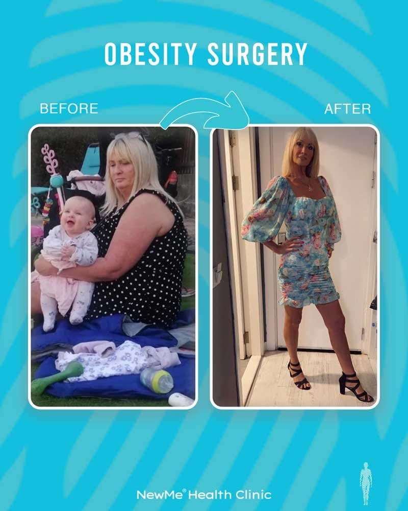 Weight loss surgery before and after — NewMe Health Clinic patient