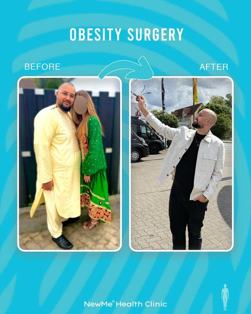 Obesity surgery before and after — NewMe patient