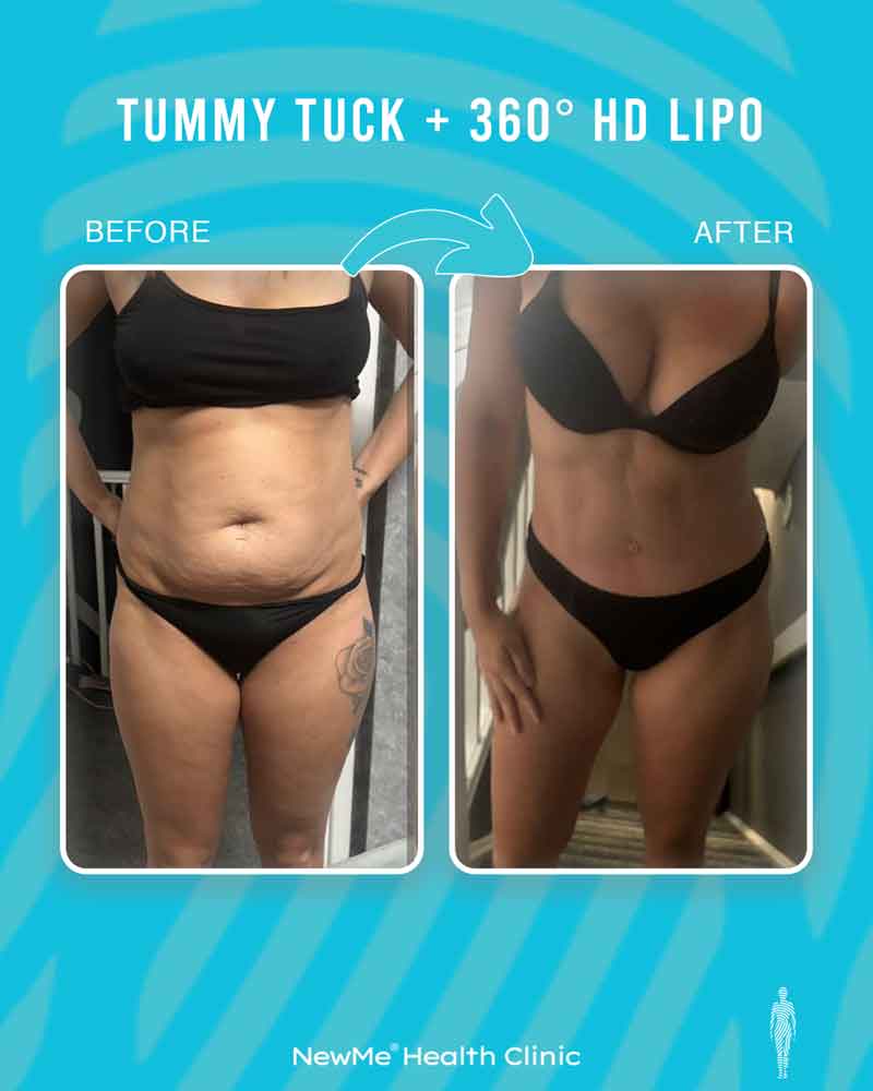 Houtan 360° Tummy Tuck + HD Lipo before and after — NewMe patient