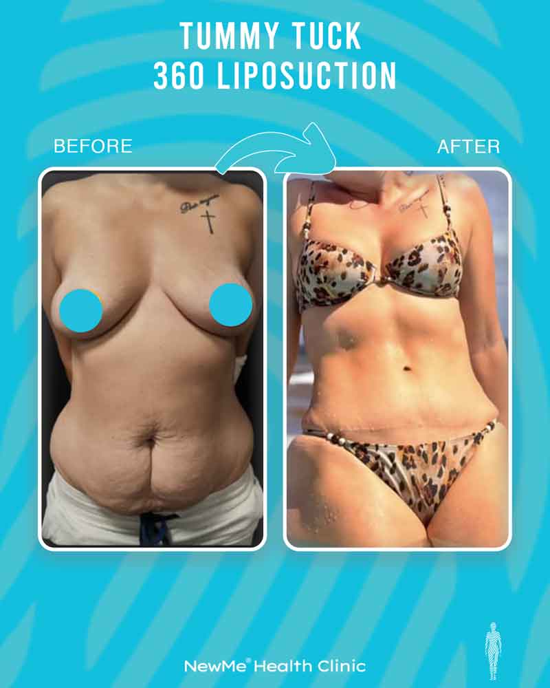 Houtan 360° Tummy Tuck + Liposuction before and after — NewMe patient
