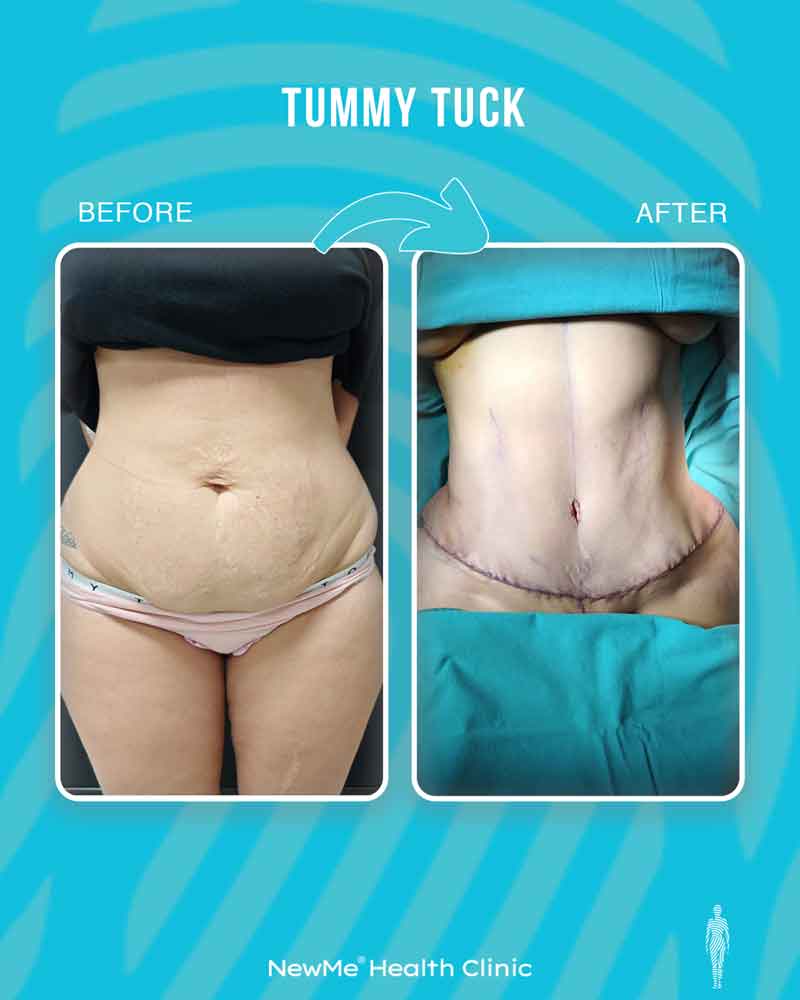 Houtan Tummy Tuck before and after — NewMe patient
