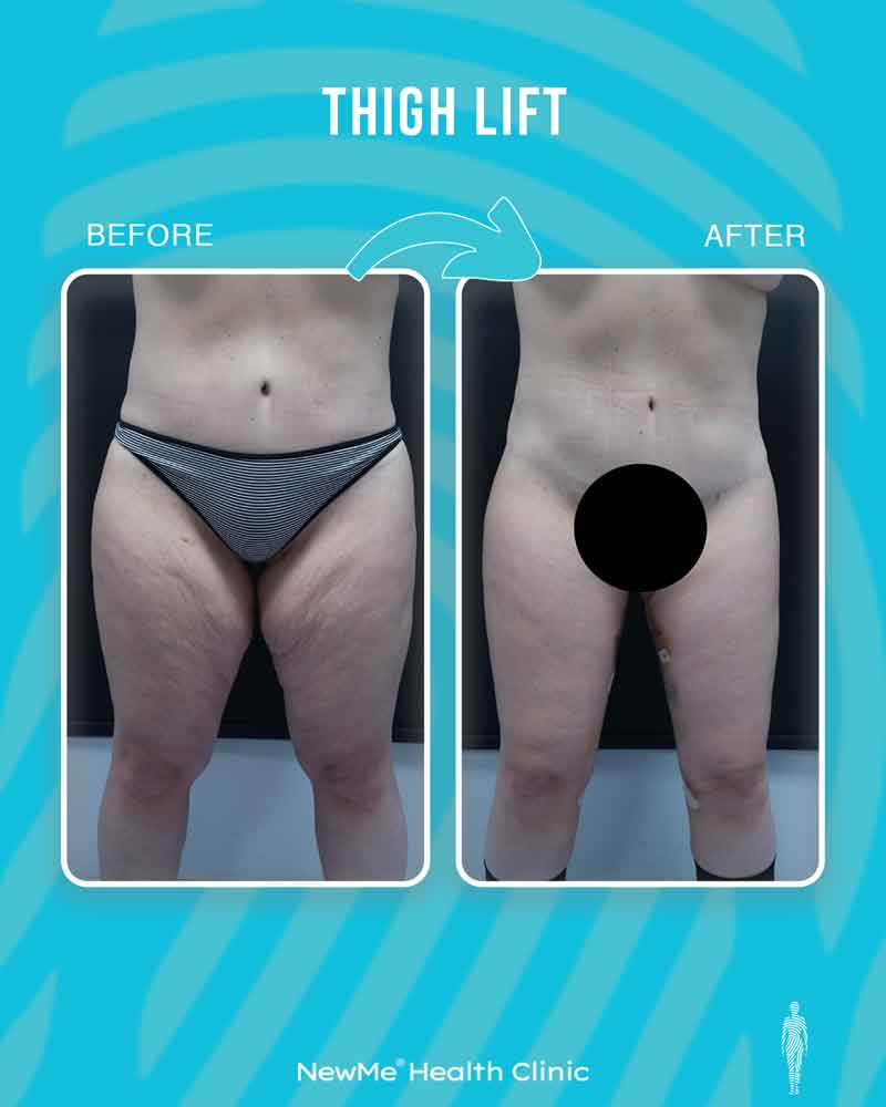Thigh lift before and after — Dr. Bahadır, NewMe patient