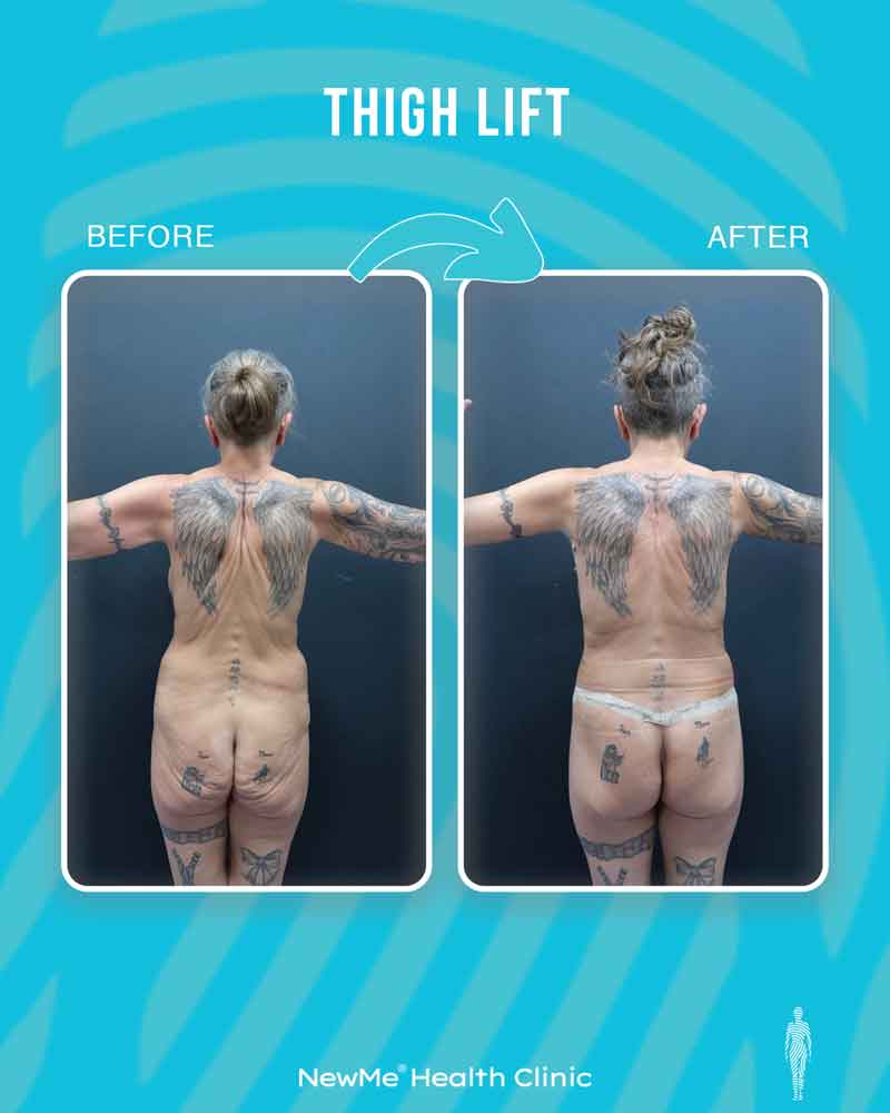 Thigh lift before and after — Dr. Bahadır, NewMe patient