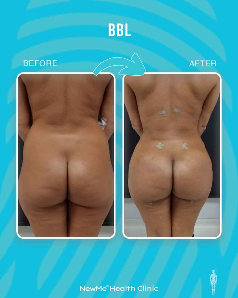 Brazilian butt lift before and after — Dr. Houtan, NewMe patient