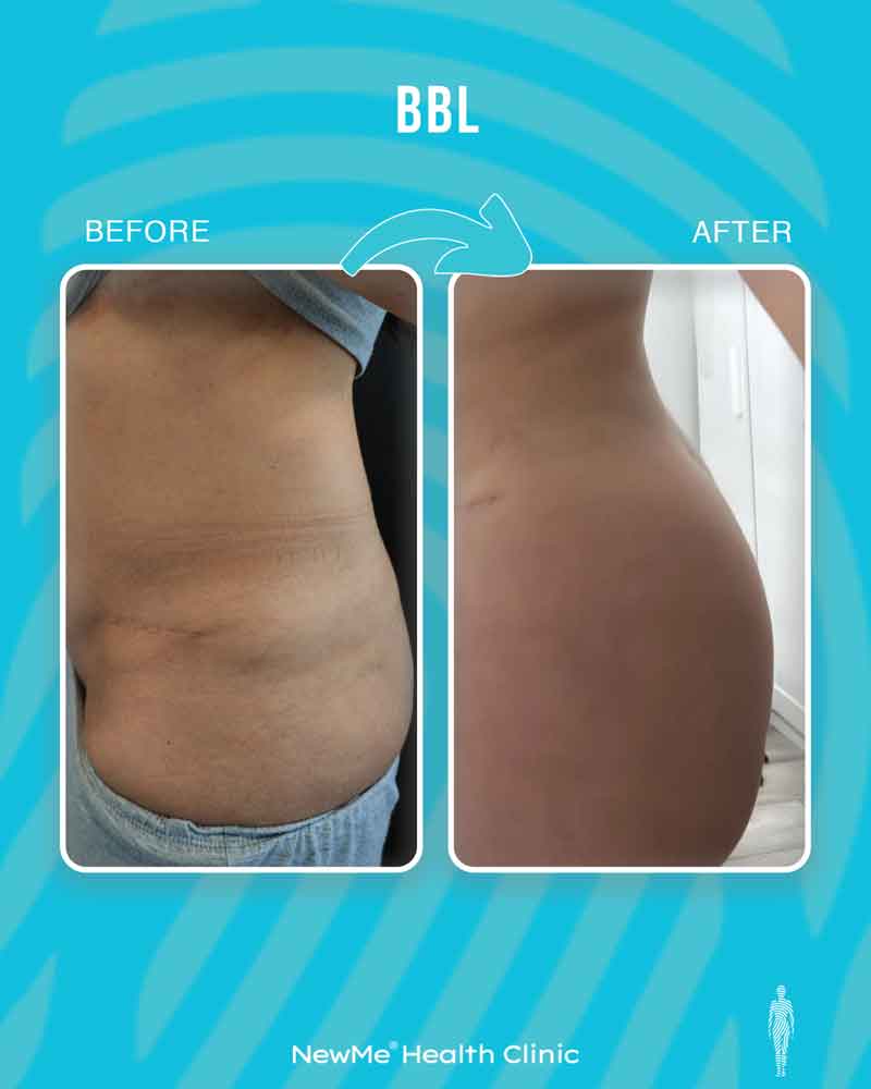 Brazilian butt lift before and after — Dr. Houtan, NewMe patient