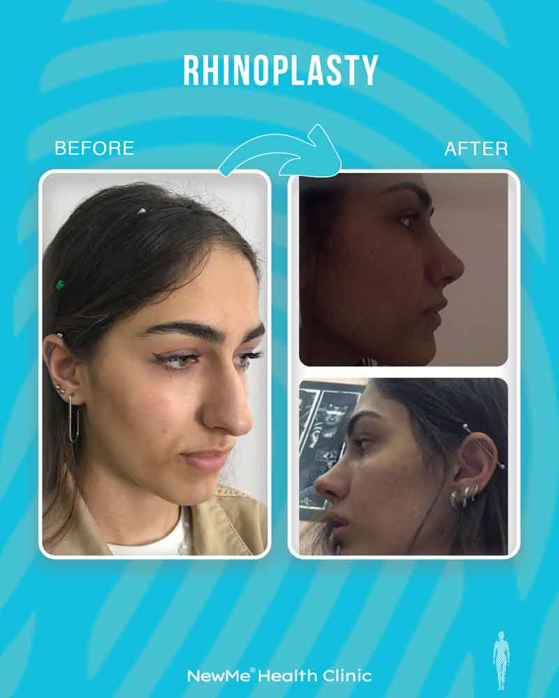 Rhinoplasty before and after — Dr. Bahadır, NewMe patient