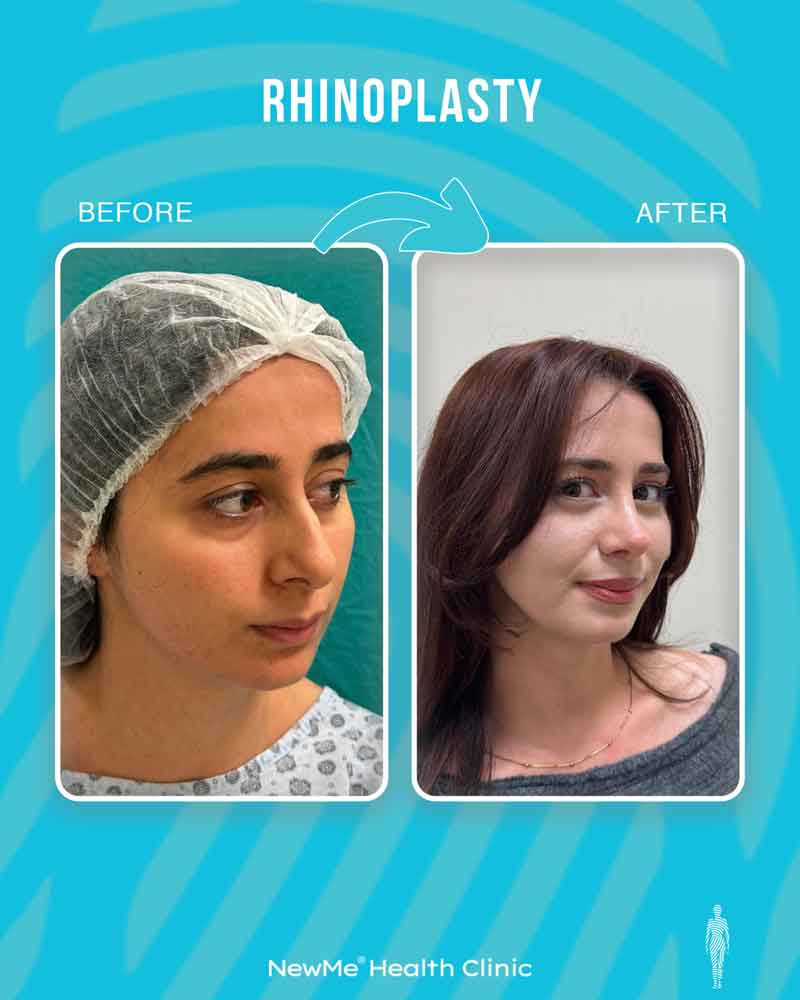 Rhinoplasty before and after — Dr. Bahadır, NewMe patient