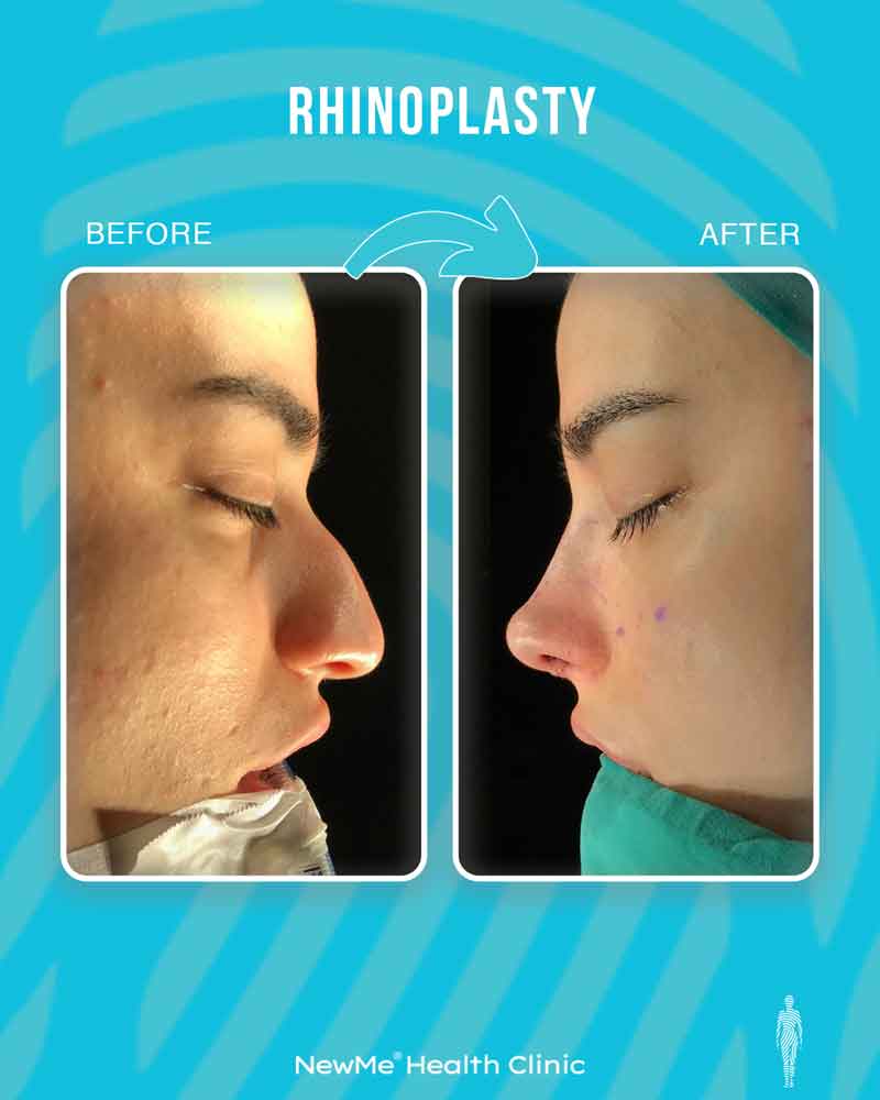 Rhinoplasty before and after — Dr. Bahadır, NewMe patient