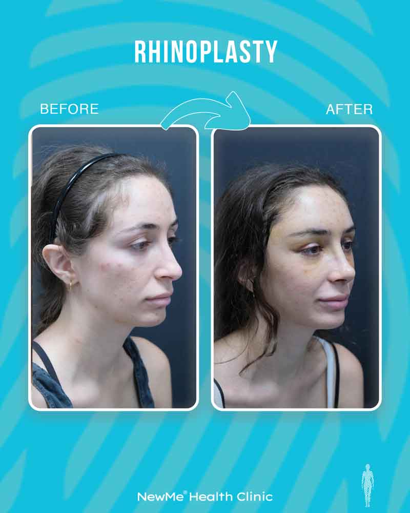 Rhinoplasty before and after — Dr. Bahadır, NewMe patient
