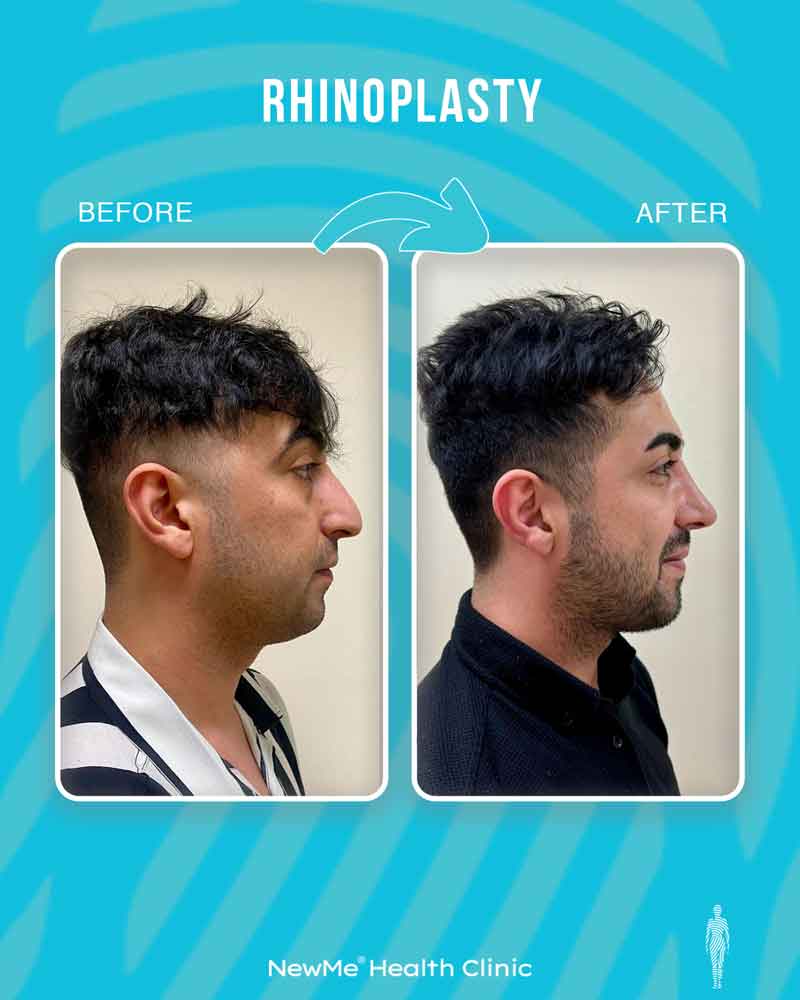 Rhinoplasty before and after — Dr. Bahadır, NewMe patient