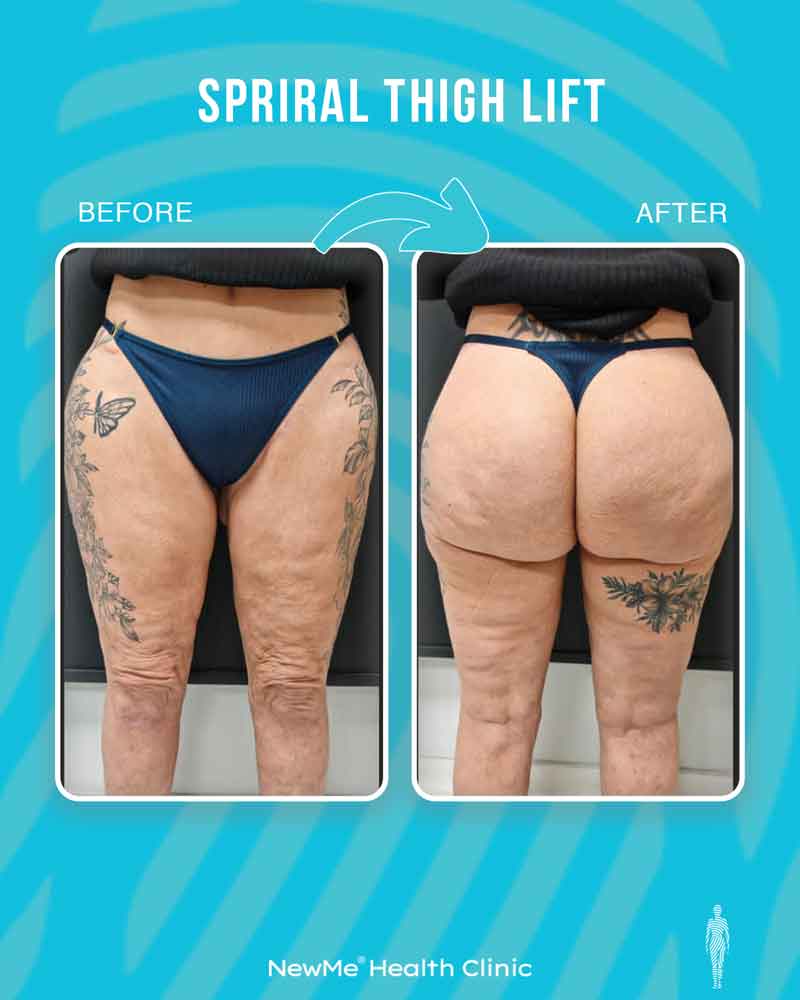 Thigh lift before and after — Dr. Houtan, NewMe patient
