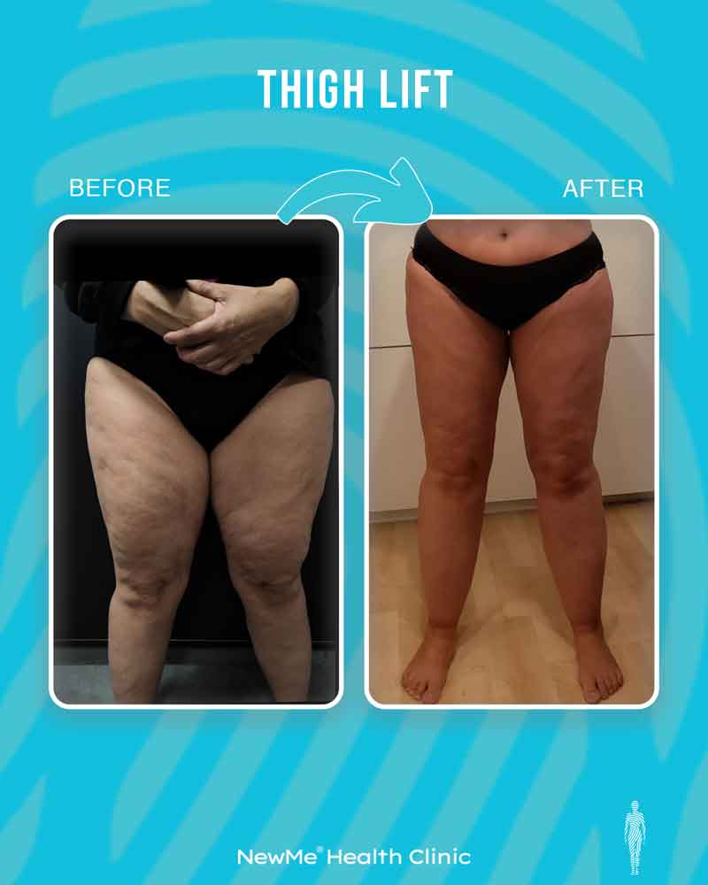 Thigh lift before and after — Dr. Houtan, NewMe patient