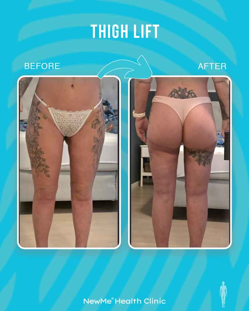 Thigh lift before and after — Dr. Houtan, NewMe patient