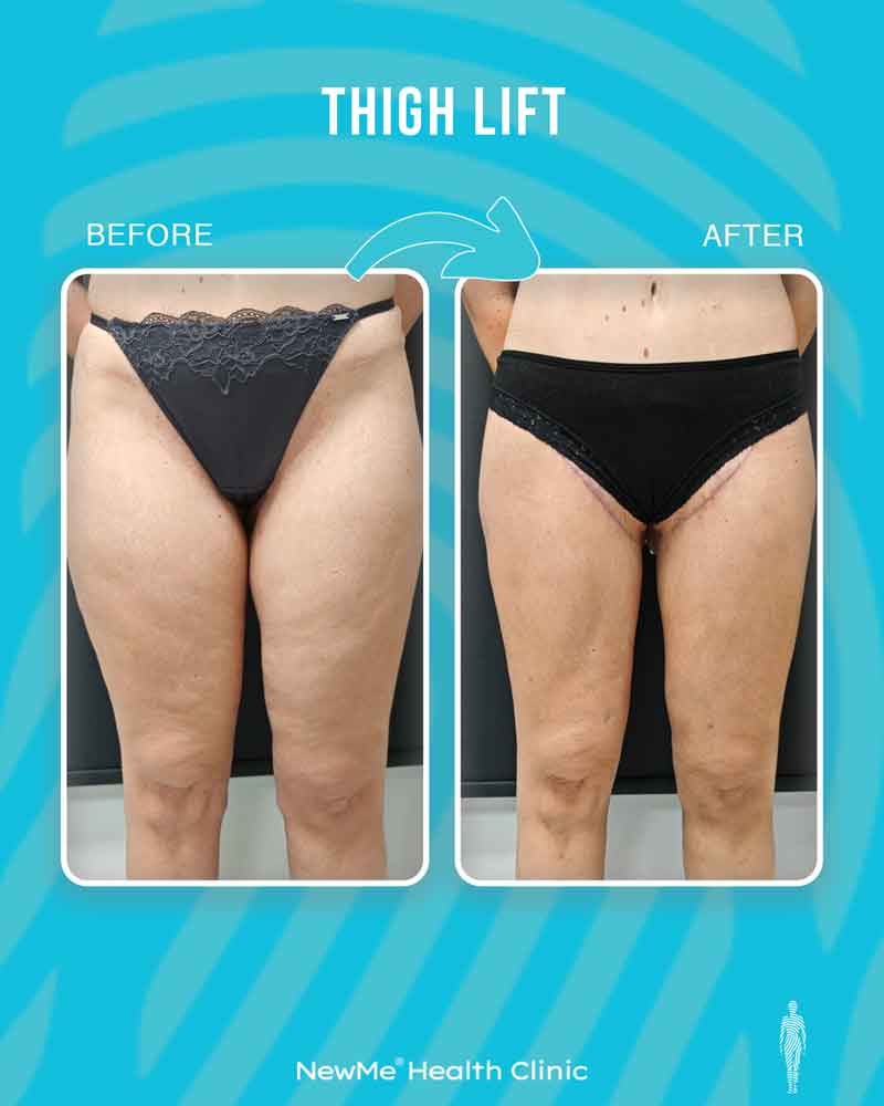 Thigh lift before and after — Dr. Houtan, NewMe patient