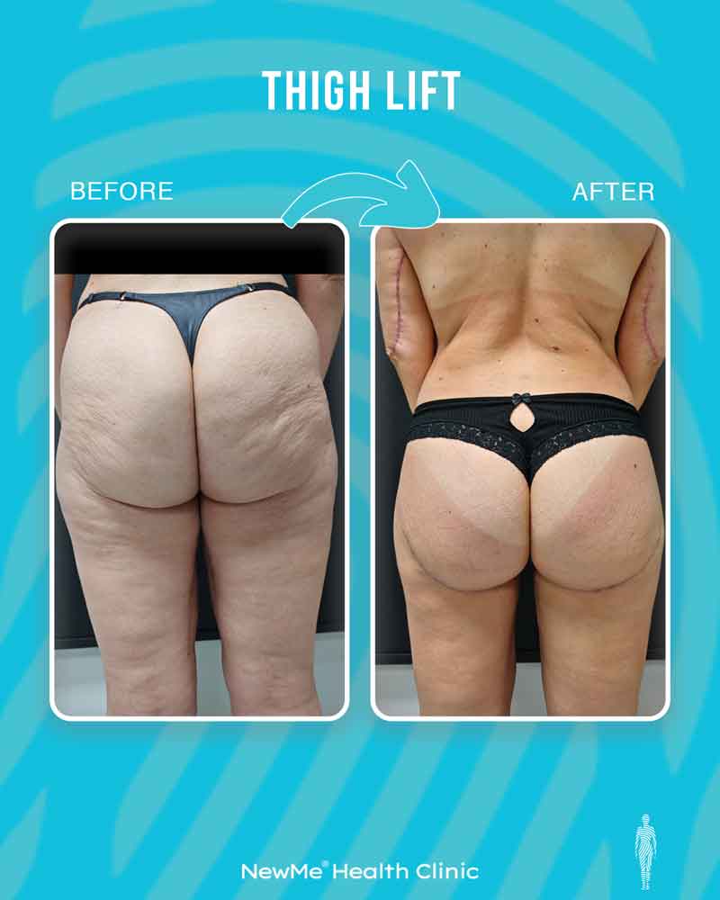 Thigh lift before and after — Dr. Houtan, NewMe patient