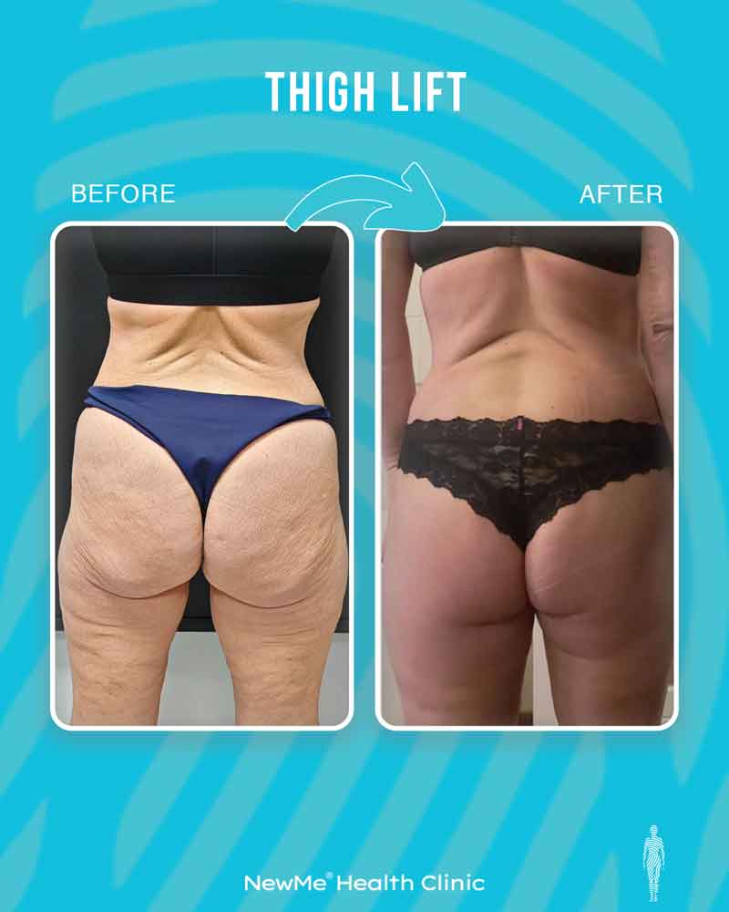 Thigh lift before and after — Dr. Houtan, NewMe patient